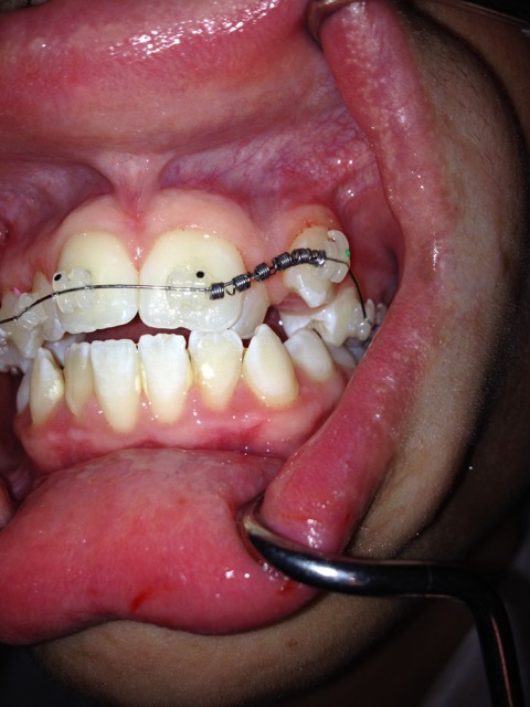 Putrino Speeckaert - Orthondontie, Dentiste Bruxelles