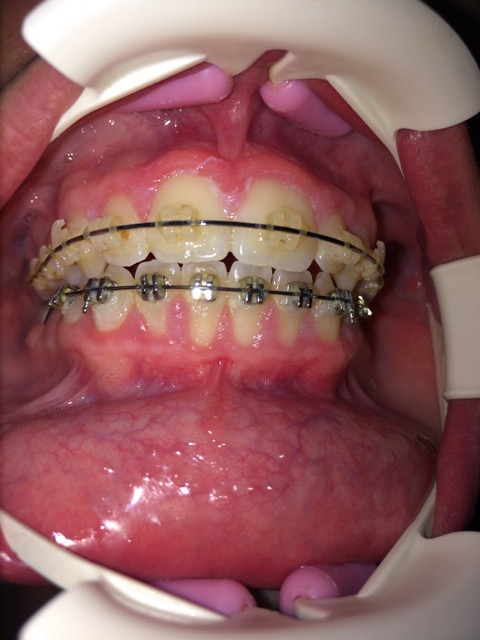Putrino Speeckaert - Orthondontie, Dentiste Bruxelles