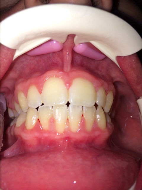 Putrino Speeckaert - Orthondontie, Dentiste Bruxelles